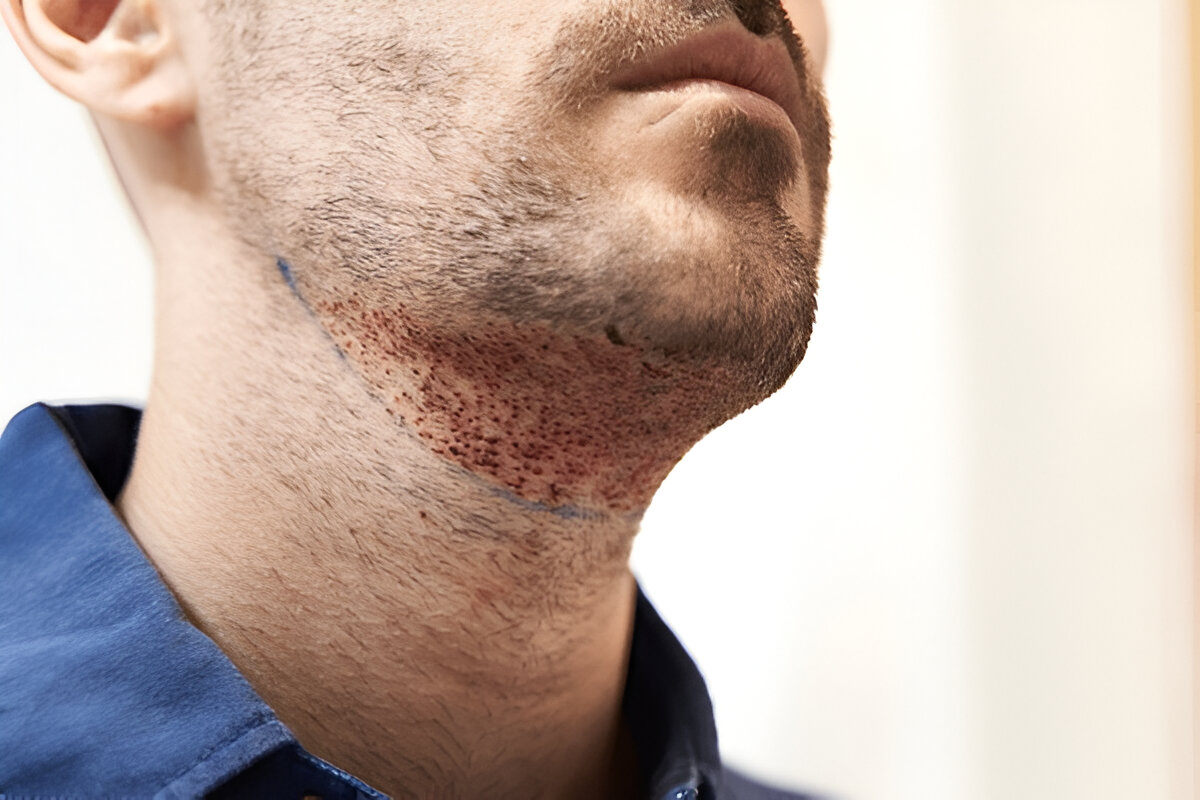 Hair Transplant