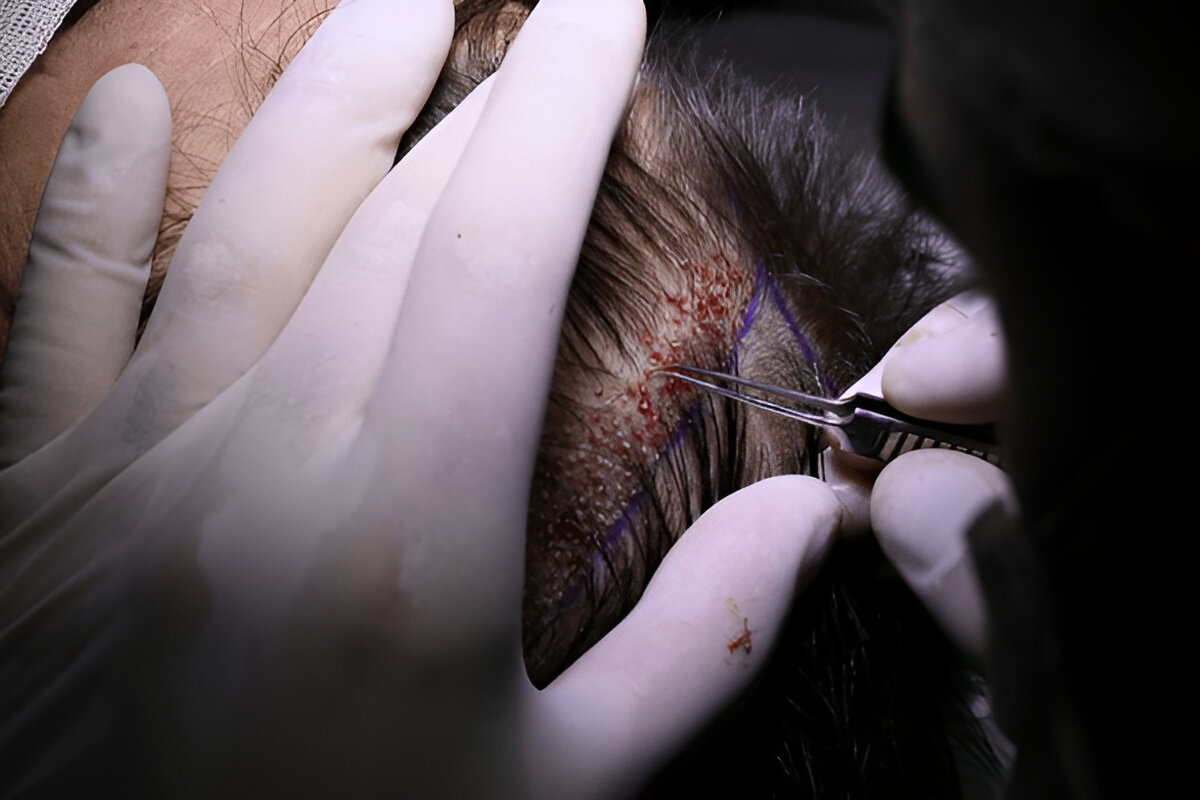 hair transplant UK