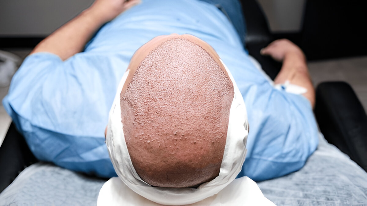 hair transplant UK