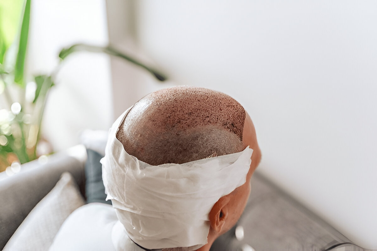 Hair Transplant