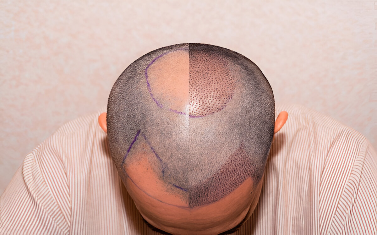 hair transplant
