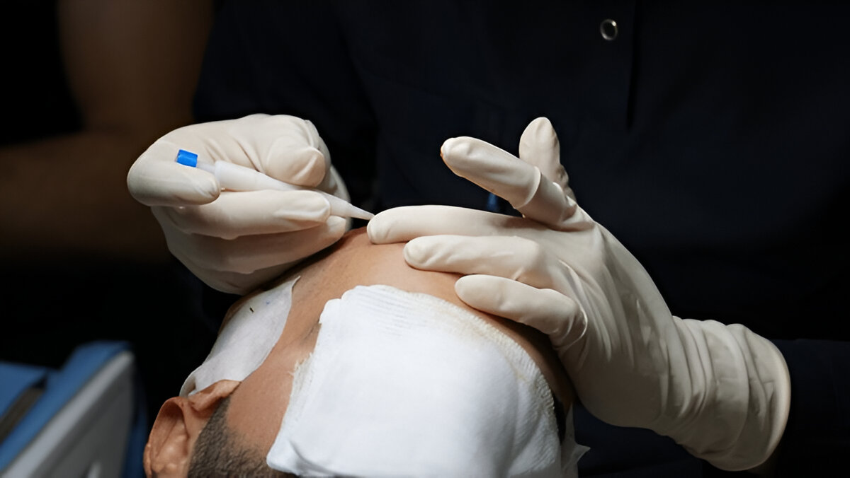 Hair Transplant