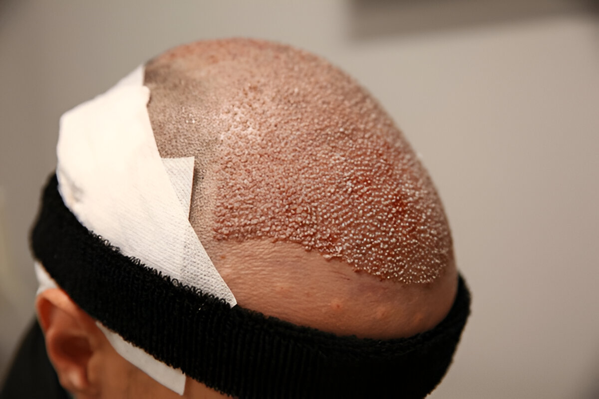 Hair Transplant