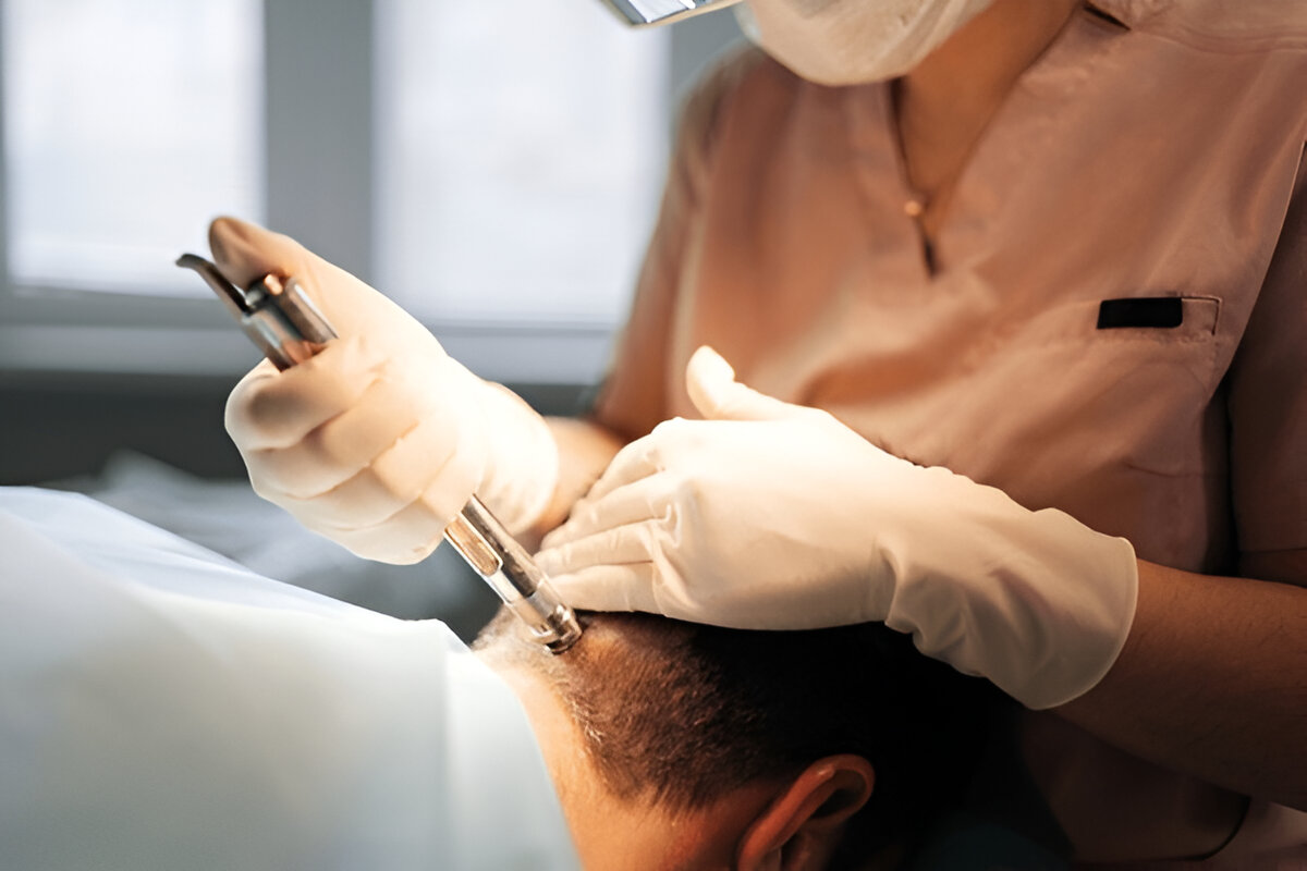 Manual hair transplant London