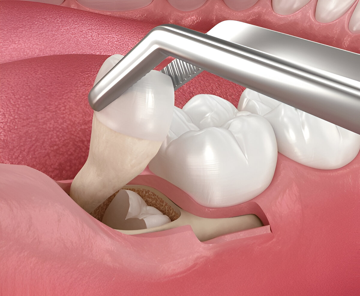 wisdom teeth extractions