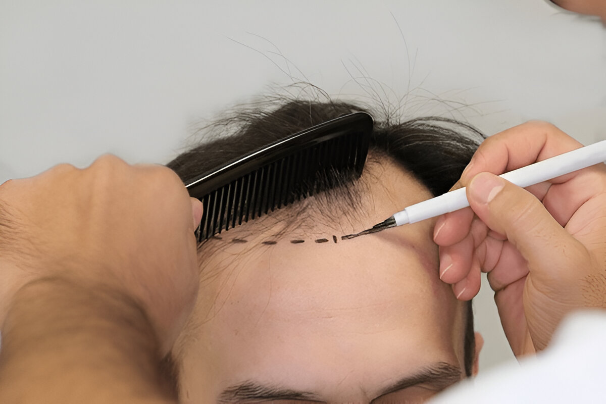 hair transplant UK