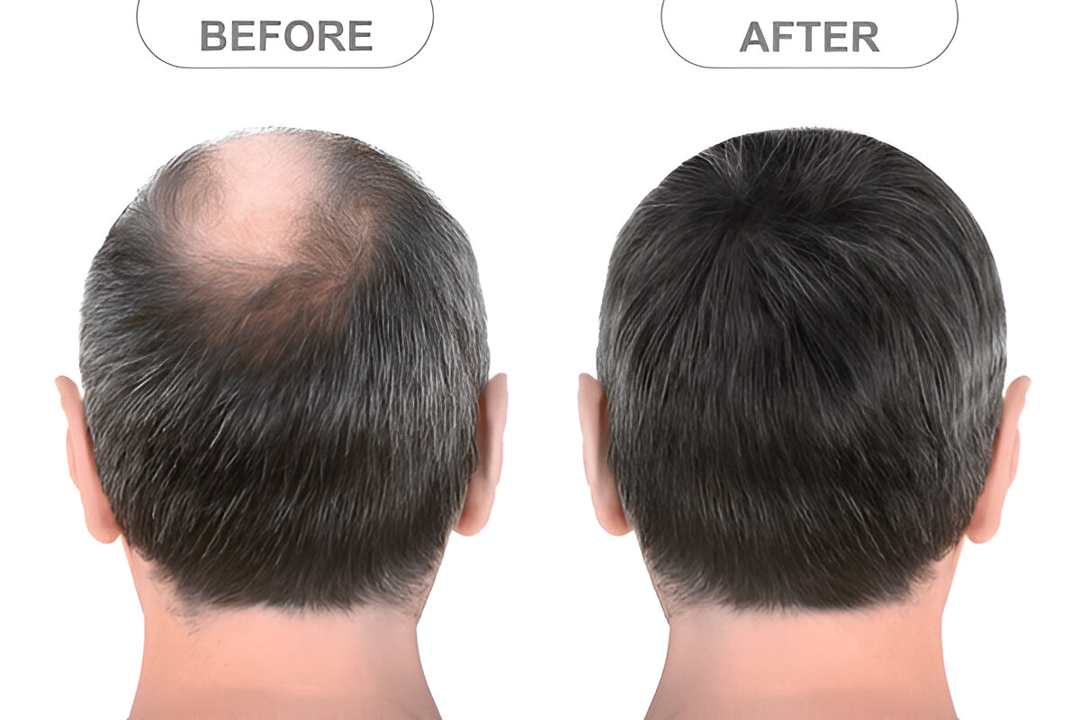 hair transplant Cardiff