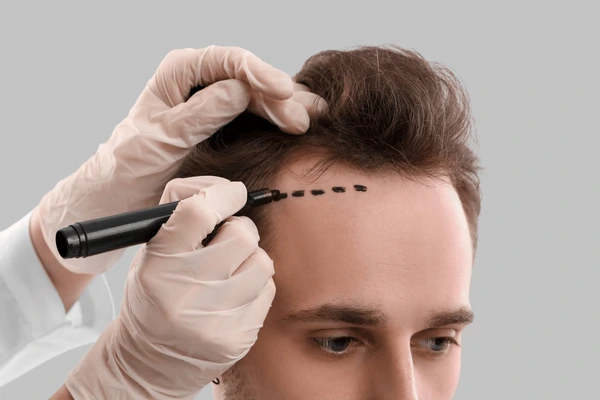 Hair transplant UK